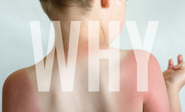 Why text over a child with a sunburnt back